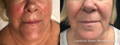 Woman's face before and after Lumecca IPL for redness