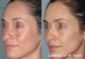 Woman's cheek before and after Lumecca IPL for pigment
