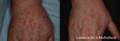女人的手在Lumecca IPL之前和之后的色素