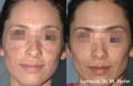 女人的脸在Lumecca IPL之前和之后的色素