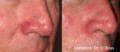 Nose before and after Lumecca IPL for visible capillaries
