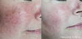 妇女的脸颊在Lumecca IPL前后为红肿