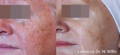 妇女的脸颊在Lumecca IPL之前和之后的色素