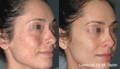 Woman's freckled cheek before and after Lumecca IPL