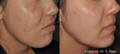 卢梅卡IPL 色素前后女性脸颊