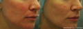 Lumecca IPL前后女性红脸的侧视图