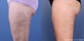 Side view of woman's thigh before and after Morpheus8