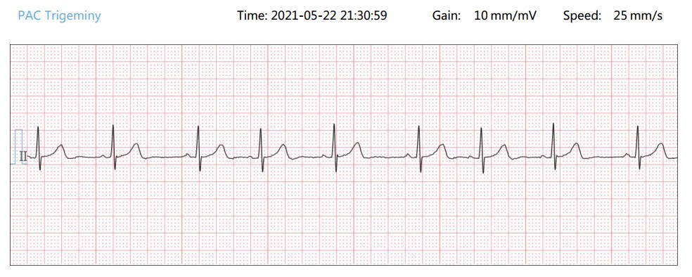 Forma de onda de ECG de PAC Trigeminy