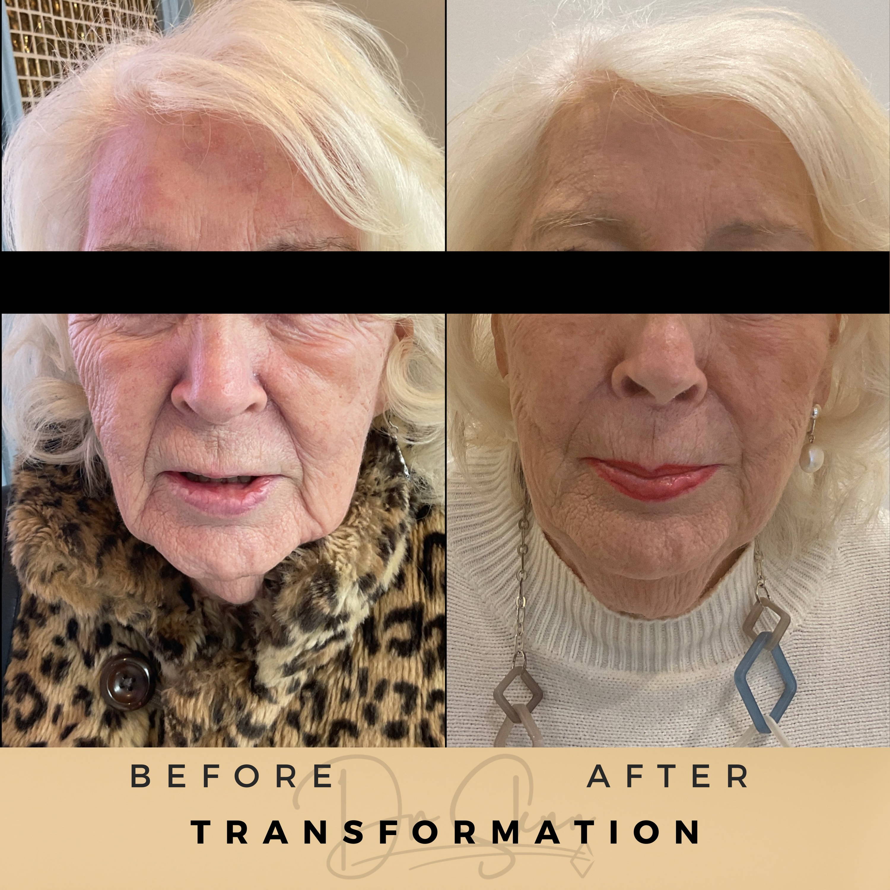 Non Surgical Aesthetics Wilmslow Before and Afters