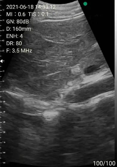 EagleView portable ultrasound image-right lobe of liver
