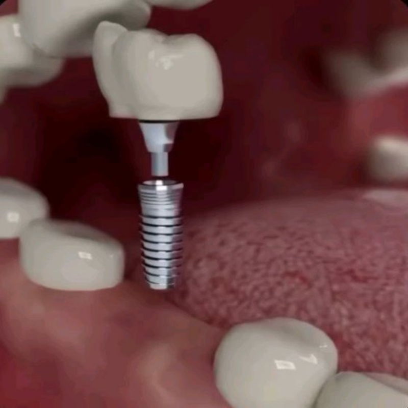 Haben Sie eine Lücke?🦷

Wir haben die Lösung!

•Was ist ein Implantat?

- Ist ein künstliche Zahnwurzel, die in den Kieferknochen eingesetzt wird um die Lücke zu schließen!

- Es besteht in der Regel aus Titan oder Keramik & dient als stabile Basis f