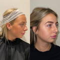Non-Surgical Face Lift and Neck Lift Dr Sknn Before and After 1
