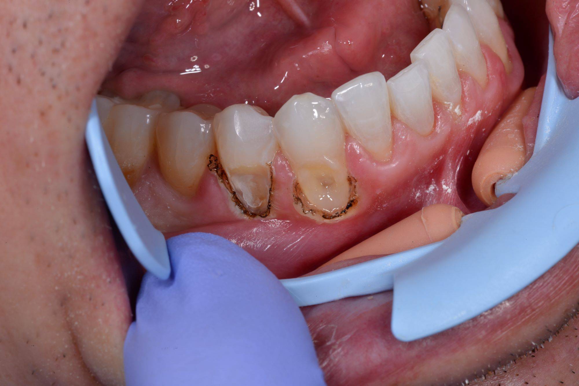 Subgingival decay exposed with burnt gums around it