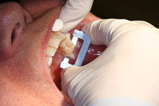Hand with gloves performing procedure in back upper tooth using a white serrated strip