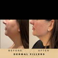 Chin Fillers Wilmslow Before & After Dr Sknn