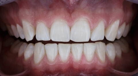 laserglow after teeth whitening