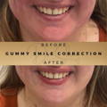 Gummy Smile Correction Fillers Before & After