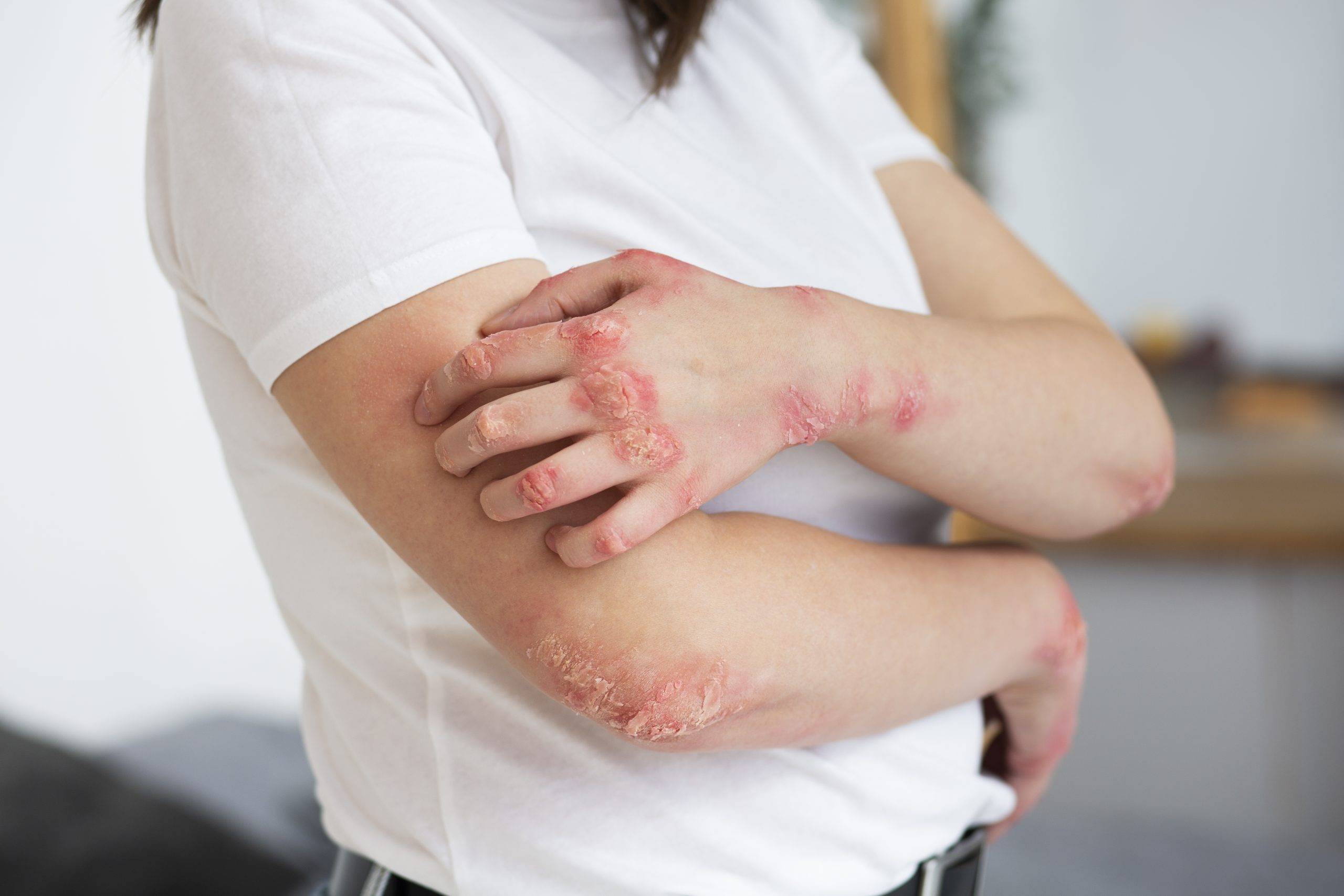 Dengue Signs