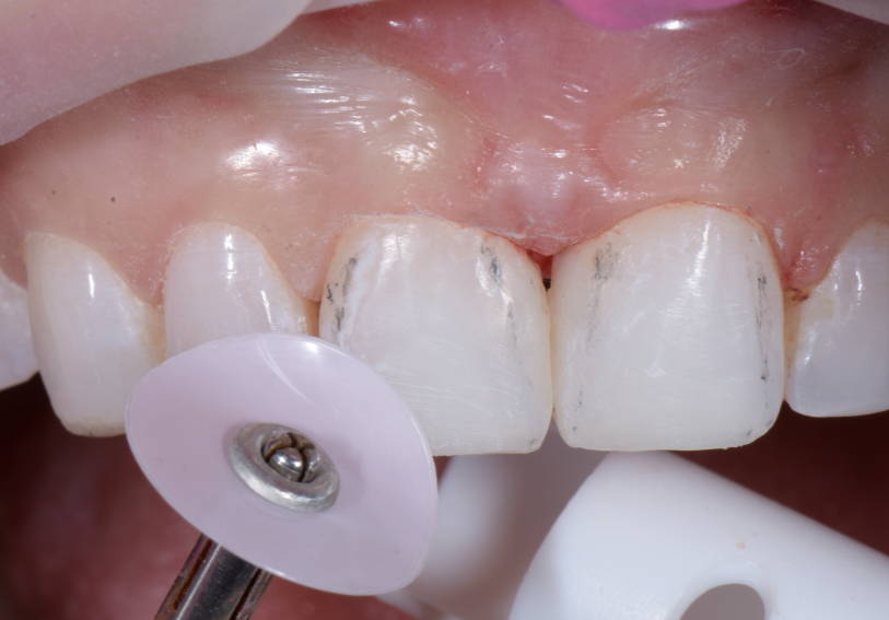 Pink polisher polishing upper anterior tooth