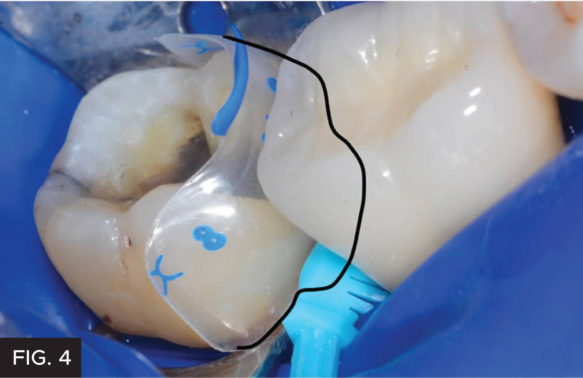 Class II Restoration: Bioclear. Fig. 4