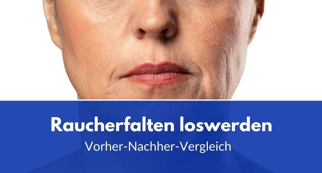 raucherfalten loswerden