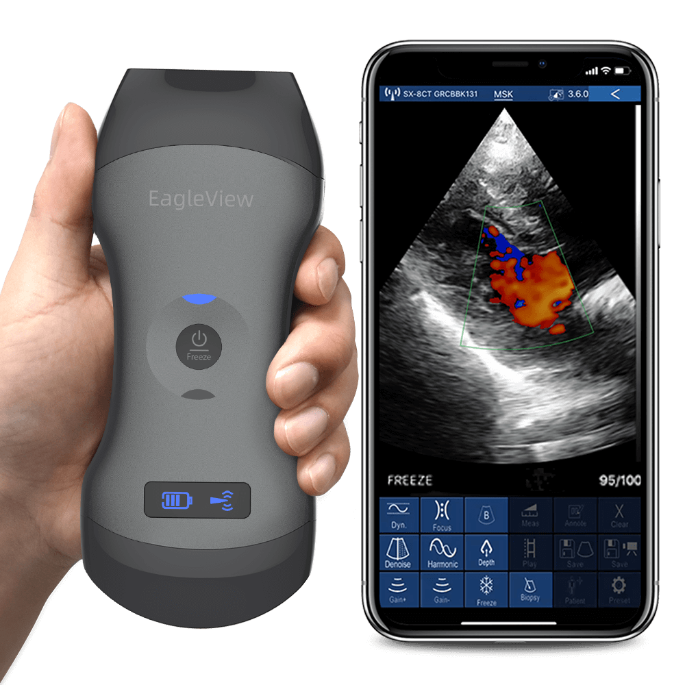 Eagleview Wireless Probe Type Ultrasound Scanner