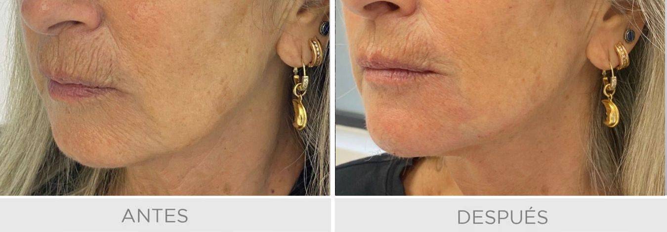 hialuronico mandibula volumen