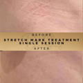 Stretch Marks Treatment CO2 Fractional Ablative Laser Wilmslow Before & After Dr Sknn