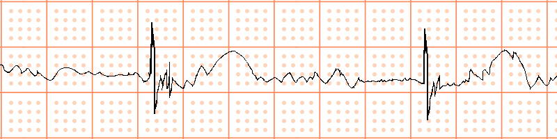ECG waveforms after filtering by ie300 ECG machine is clear to read.
