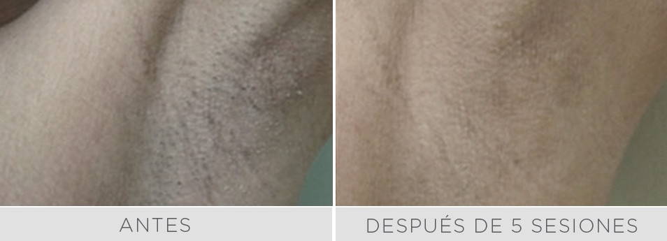 Antes y después de 5 sesiones de depilación láser en axilas