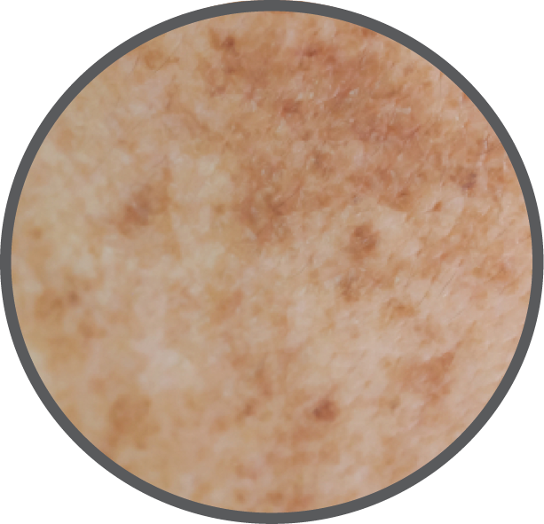Uneven Skin Tone Zoomed In | Revoderm