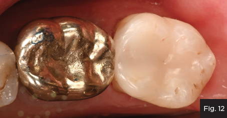 Final result with restored molar