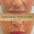 Nasolabial Fold Fillers Wilmslow