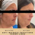 Frown Line Anti-Wrinkle Injections Wilmslow
