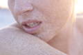 sensitive skin with freckles