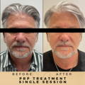 Before & After Pictures Dr Sknn Wilmslow Cheshire