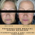 Anti-Wrinkle and Pigmentation Personalised Skincare Dr Sknn Before & After