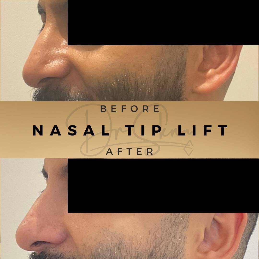 Nasal Tip Anti-Wrinkle Injections Wilmslow Before & After Dr Sknn