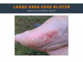 Large area edge blister