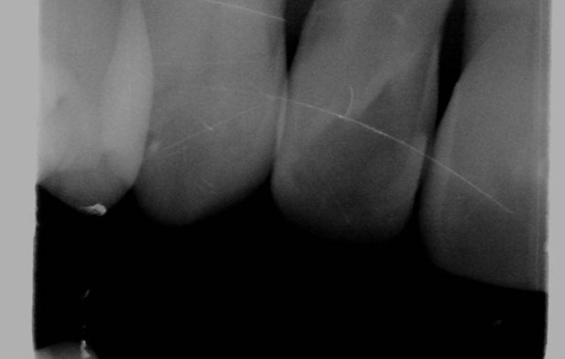 Tooth x-ray black and white 