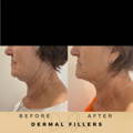 Jaw Fillers Wilmslow Before & After Dr Sknn