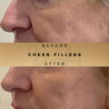 Cheek Fillers Wilmslow