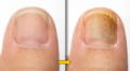 Animated Toenail Fungus