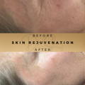 Skin Rejuvenation Wilmslow Dr Sknn Before & After Picture
