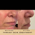 Before & After Pictures Dr Sknn Wilmslow Cheshire