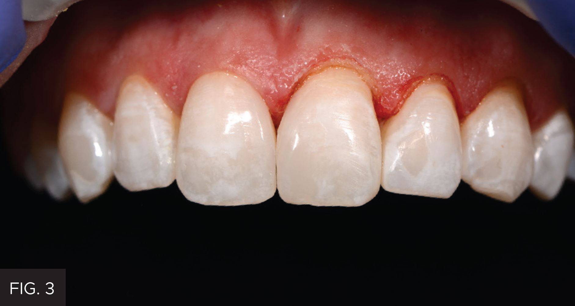 Gingival Sculpting With a Soft Tissue Diode Laser: Figure 3
