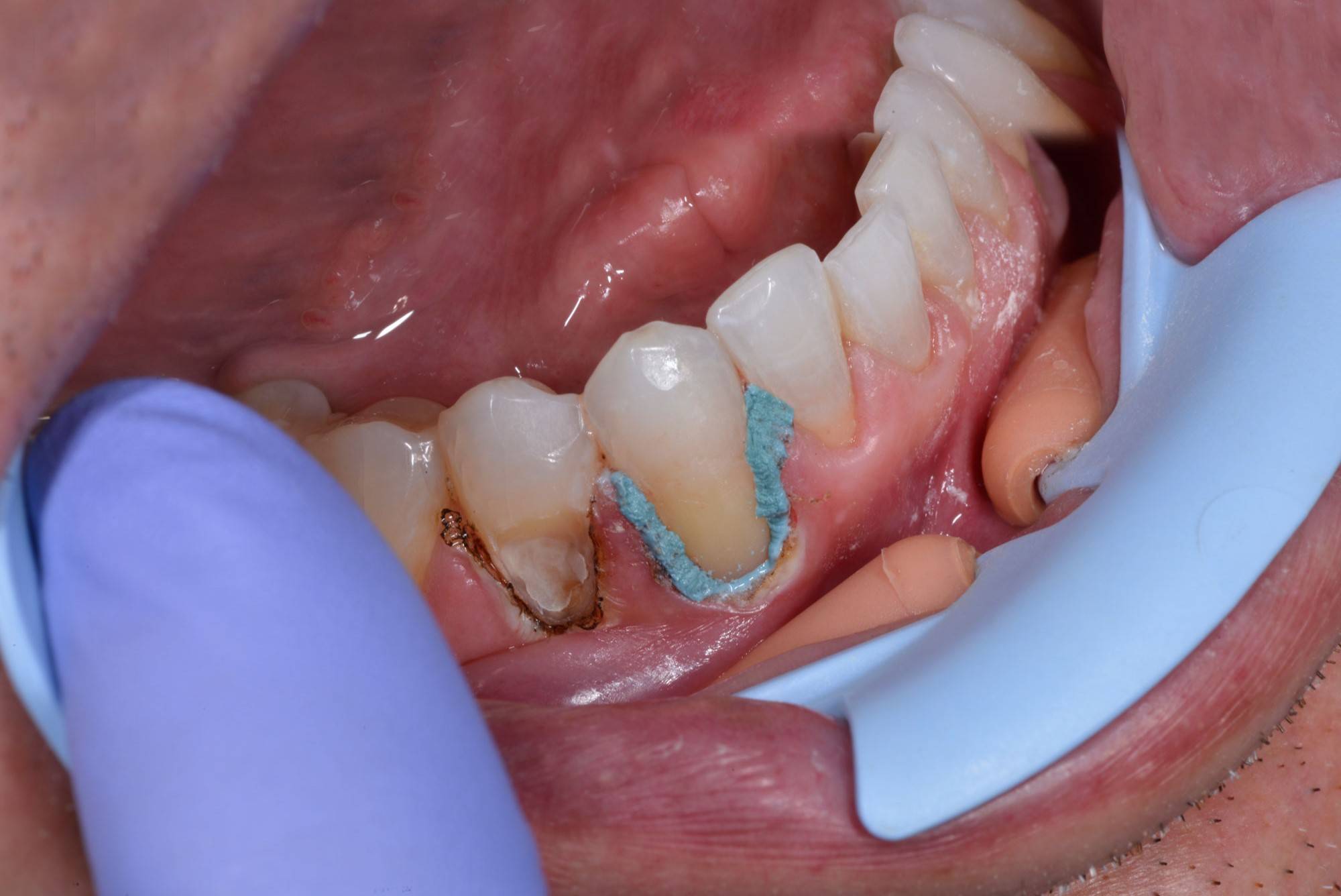 Protective green layer applied around tooth