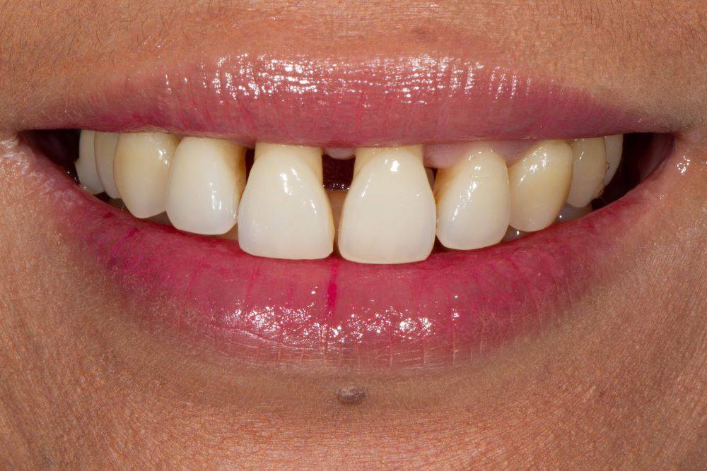 Close-up smile showcasing severe black triangles in upper incisors