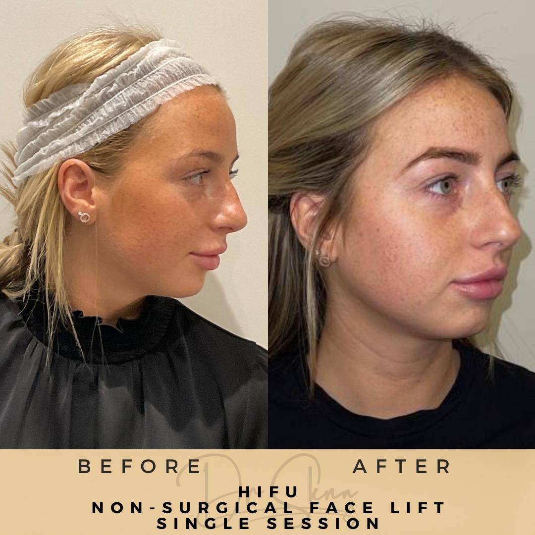 Non-surgical Facelift (HIFU) - Dr Sknn before and after