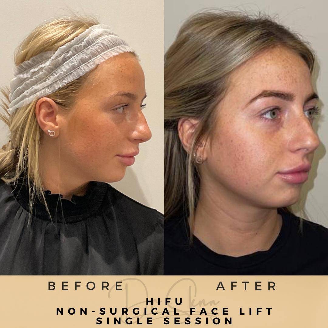 Non-Surgical Facelift HIFU Wilmslow Before & After Dr Sknn
